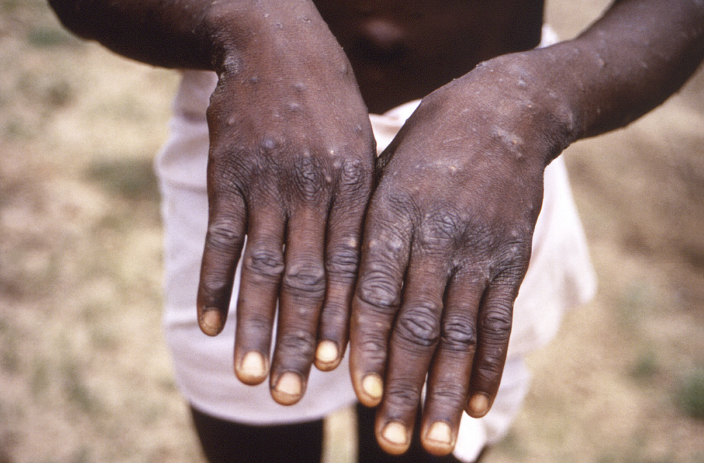 Estigma contra homosexuales podría agravar brote de viruela símica en el Congo, dicen científicos
