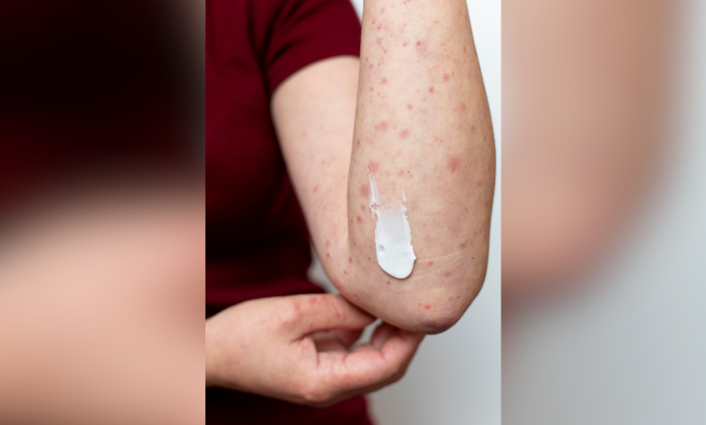 Suman cuatro casos de viruela símica en Yucatán